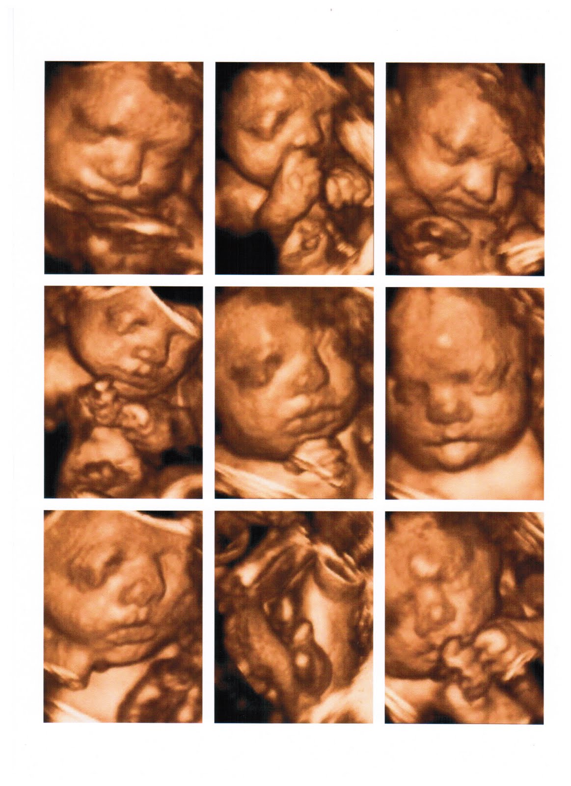 The Kearn Family Adventures Precious Previews 3D/4D Ultrasound